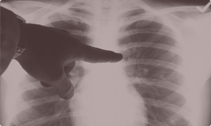 A doctor’s hand pointing to a highlighted area on a chest X-ray image.