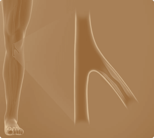Medical illustration of a human leg with a close-up view of narrowed arteries, depicting peripheral artery disease (PAD) and restricted blood flow.