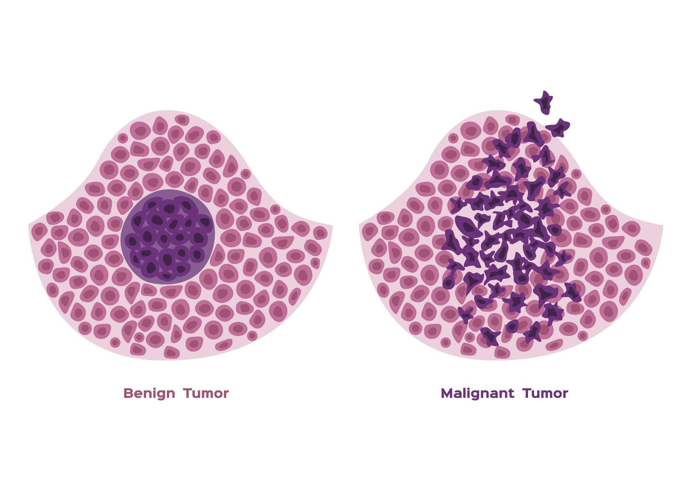 Difference Between a Benign and Malignant Tumor