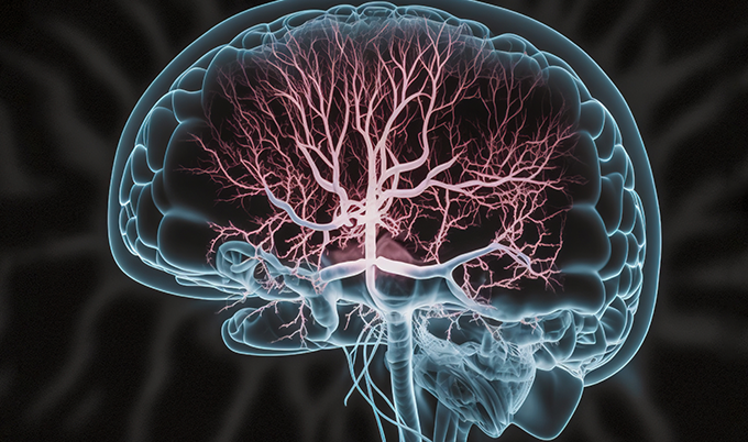Illustration demonstrating how microvascular ischemic disease affects blood vessels in the brain