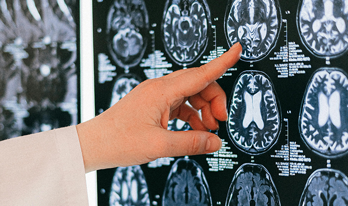Brain MRI scan showing white matter lesions associated with chronic small vessel ischemic disease