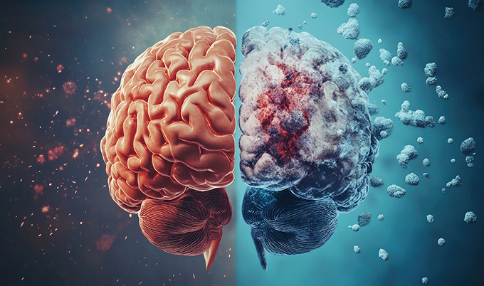 Person experiencing cognitive symptoms from chronic small vessel ischemic disease including memory and balance issues