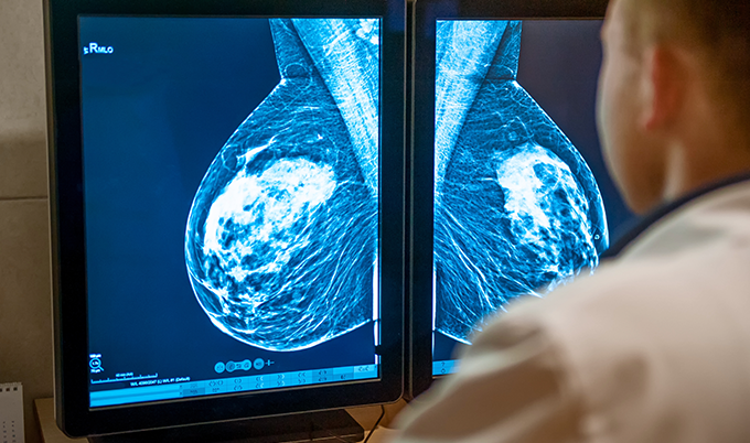 Medical illustration showing benign breast conditions that can appear abnormal on mammograms