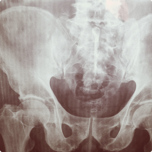 An X-ray image of the pelvis and lower spine, showing bone structure and alignment.